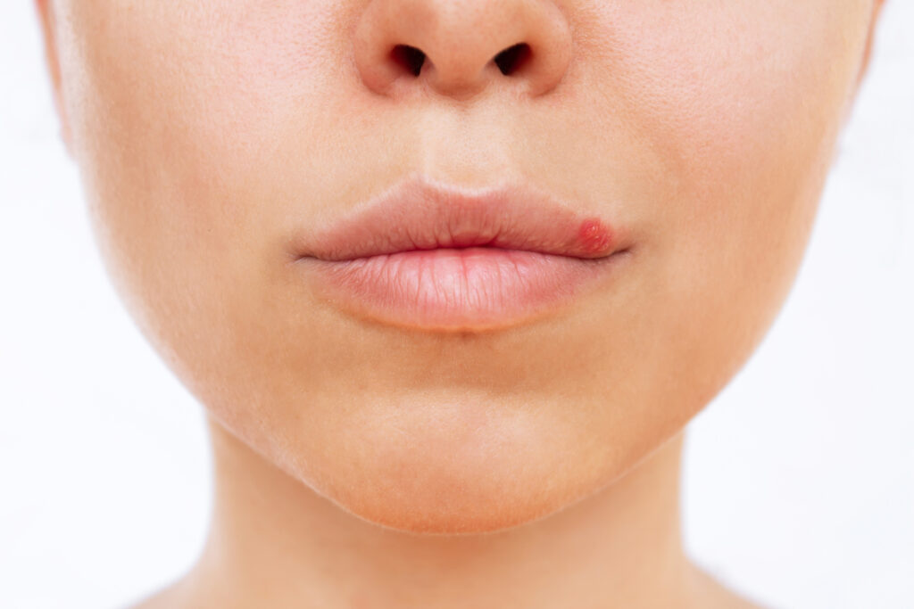 Close-up of a person’s lower face showing a visible red bump on the lip, trying to distinguishing between a cold sore and a lip pimple