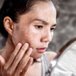 Close-up of a woman examining dark spots on her face in a mirror, showing concerns about hyperpigmentation