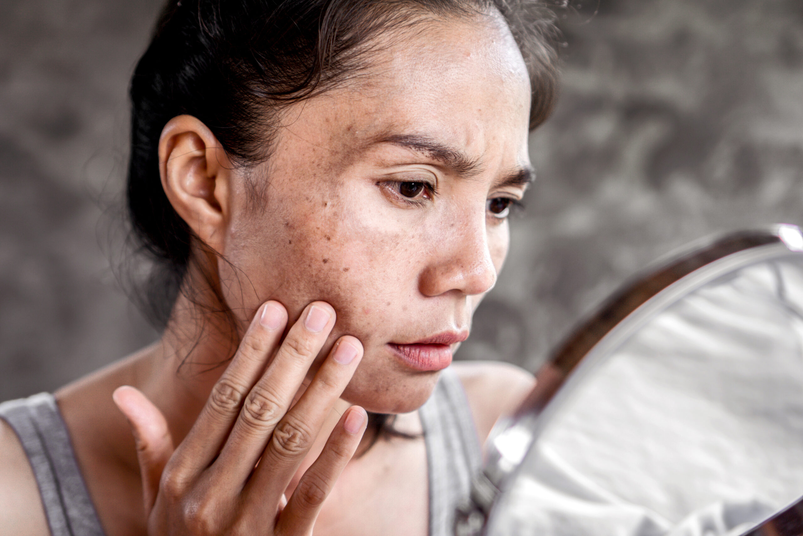 Close-up of a woman examining dark spots on her face in a mirror, showing concerns about hyperpigmentation