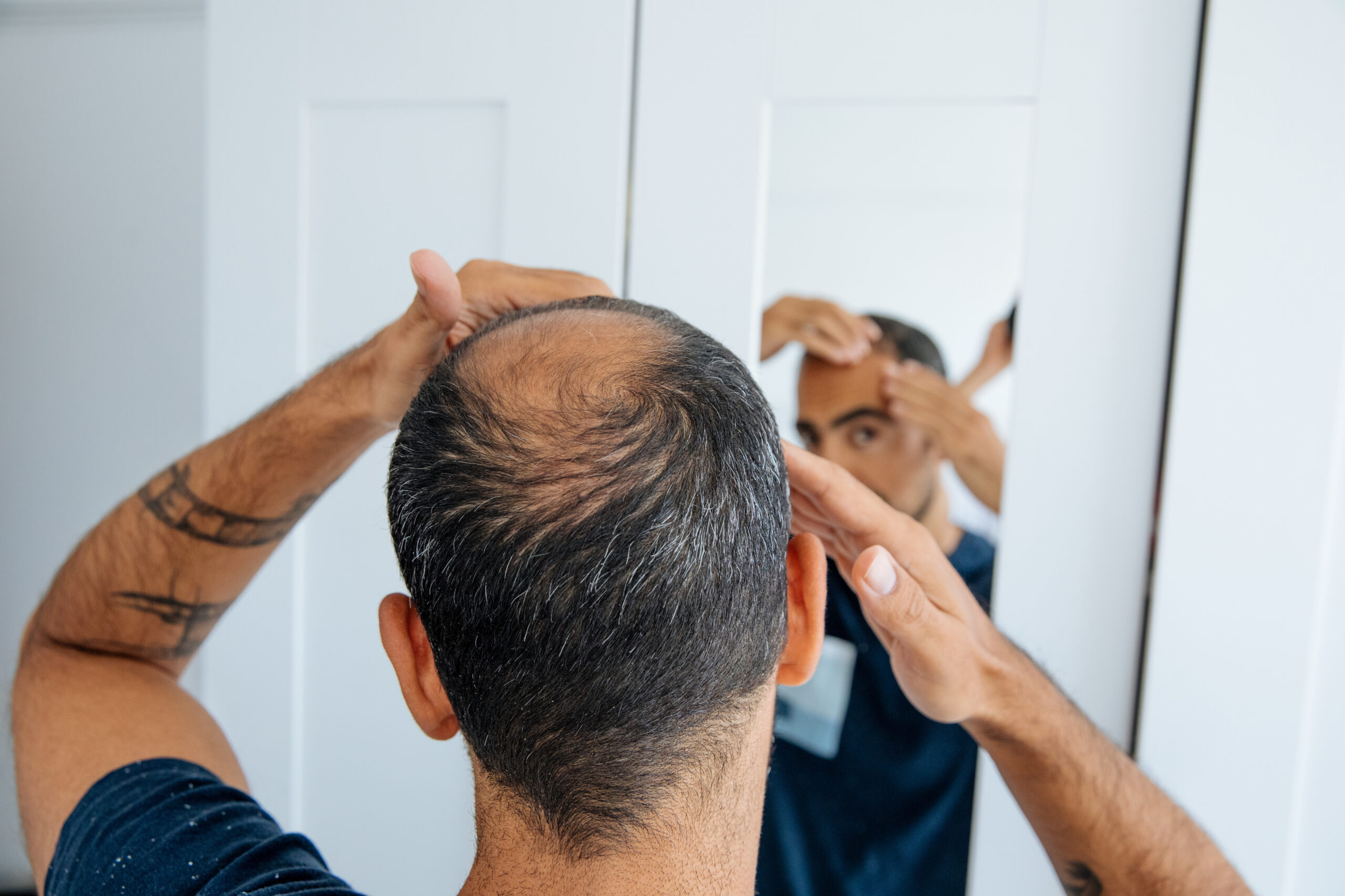 A man examining his baldness in the mirror, reflecting concerns about hair loss and potential treatments such as medications, over-the-counter solutions, and hair transplant options.